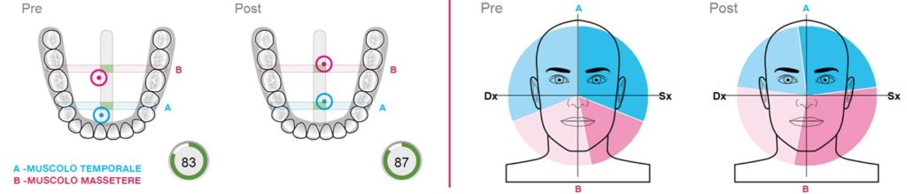 valutazione elettromiografica superficiale dei muscoli della bocca